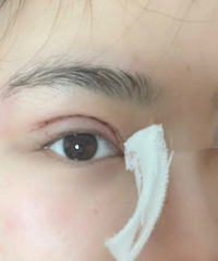 4700做了“妈生”款双眼皮,不得不说确实自然