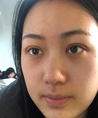 埋线双眼皮来了解一下,恢复期基本上变化不大