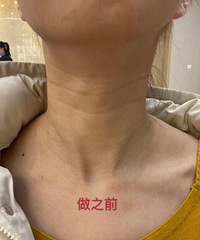 生完孩子颈纹很严重,颈霜都用遍了,终于找到有效的办法