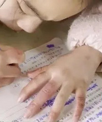 上长满冻疮,裂口流着血,无法想象这是小学生的手……