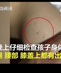 幼儿园3岁女童身上现29处针眼