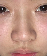 为了解决大鼻头,去做了缩鼻翼手术,你们看是不是缩了个寂寞?