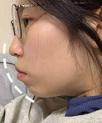baby 真的没有说谎!整了牙确实是像整容了一样