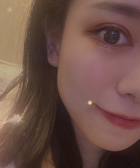 纠结星人的双眼皮之路,发帖记录一下恢复过程