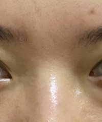 趁着春节假期,做了内切去眼袋+眶格释放,发帖记录恢复期