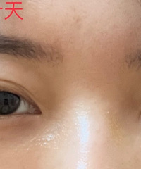 趁着春节假期,去把眼袋做了,更一下恢复期