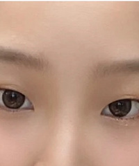 做完双眼皮第一天以为毁了,没想到恢复起来还不错