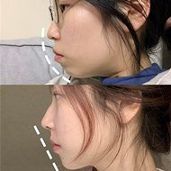 整牙效果堪比“整容”