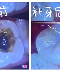 原来补牙也可以“美容”,像换了一颗新牙齿一样