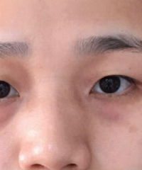 双眼皮手术把我吓哭了,还好效果还算对得起!