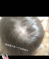 秃星人的救星,擦剂+洗发水,头发一天天长出来了