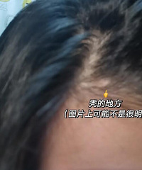 大家发际线生发有推荐的吗?