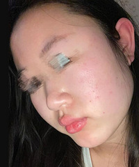 看专业医生开的药,祛痘效果真的太好了!