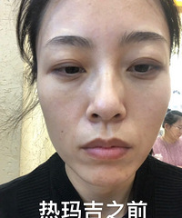 大年三十做的热玛吉,20天了终于看出来点效果