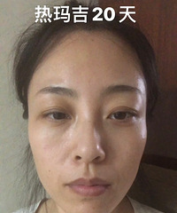 素颜无P!记录做完热玛吉20天的变化