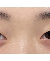 单眼皮的我做了个开扇双眼皮,自然又放大眼睛,1个月就恢复好了