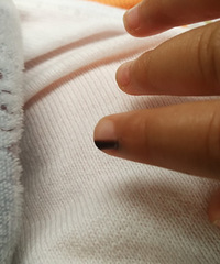 一岁宝宝甲母痣求治疗方案