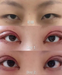重庆双眼皮:三个月的恢复日记