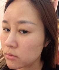 记录帖:打了4次水光补水后皮肤的变化