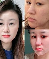 4次水光后,黑头痘痘好了,化妆都服帖