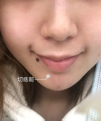 切痣祛疤分享帖:你们说改变面相能改变运气吗?