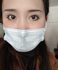第4次修复双眼皮终于成功,有一种上岸的感觉