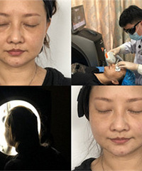 做完无痛版光子嫩肤,毛孔小了肤色也提亮