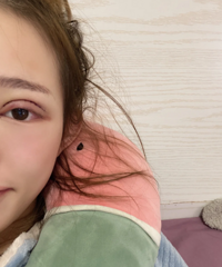 做双眼皮怎样才能不留疤?分享我的护理经验和好物,给你们参考