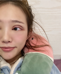 做双眼皮怎样才能不留疤?分享我的护理经验和好物,给你们参考