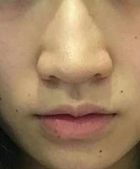 隆鼻日记:再见,毁了我整张脸的驼峰鼻