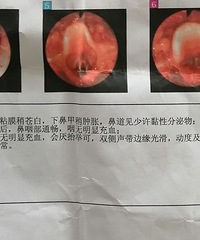 过敏性鼻炎如何治疗