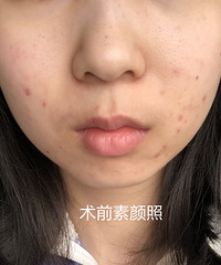 M22光子嫩肤初体验/最真实的心得反馈