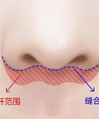 北京崔鹏医生:什么是人中缩短术?