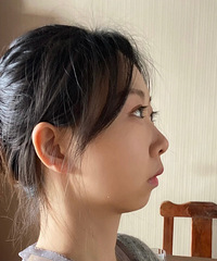 垫了下巴,侧面变化真的太大了,五一可以美美的出游了