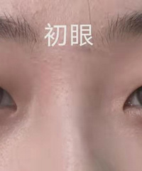“五一”出游准备!做了双眼皮,一定要拍照拍个够