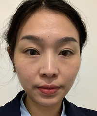 不用开刀的“割”眼袋方法,当天效果就超满意~