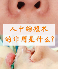 北京人中缩短医生,整形医生崔鹏案例!