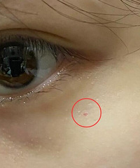 你们脸上有起过这种小血点嘛?