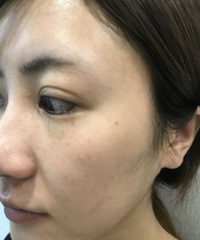 皮秒祛斑第二天斑点全部浮上来,还要上班的我该怎么办?