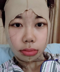 我的颧弓下颌角整形日记,脸变小了每天心情都好了