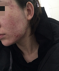 记录我的果酸焕肤过程,一点一点蜕变吧