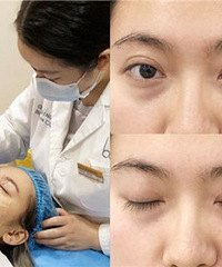 1次胜过万元护肤品,黑眼圈轻松改善
