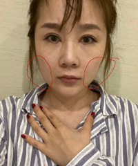 长期打瘦脸针也解决不了我的宽脸,最后去做了黄金微雕