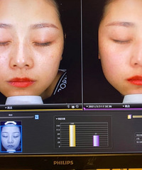 三次超皮秒总算有效果了,以后真的不能再……
