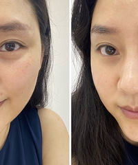 哺乳期也能做的皮肤管理,一次就能看到皮肤的改善。
