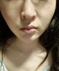 朋友想把法令纹祛除,求问什么医美项目比较好呢?