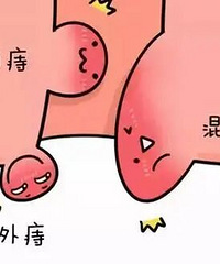 五一去做了痔疮手术,说说手术过程