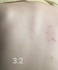 亲测有效的低成本方法,跟背部痘痘说再见】