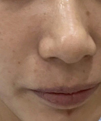 光子嫩肤初体验后,真香现场来了