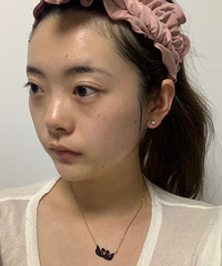 从单眼皮肿泡眼变双眼皮大眼睛,看记录像换了人